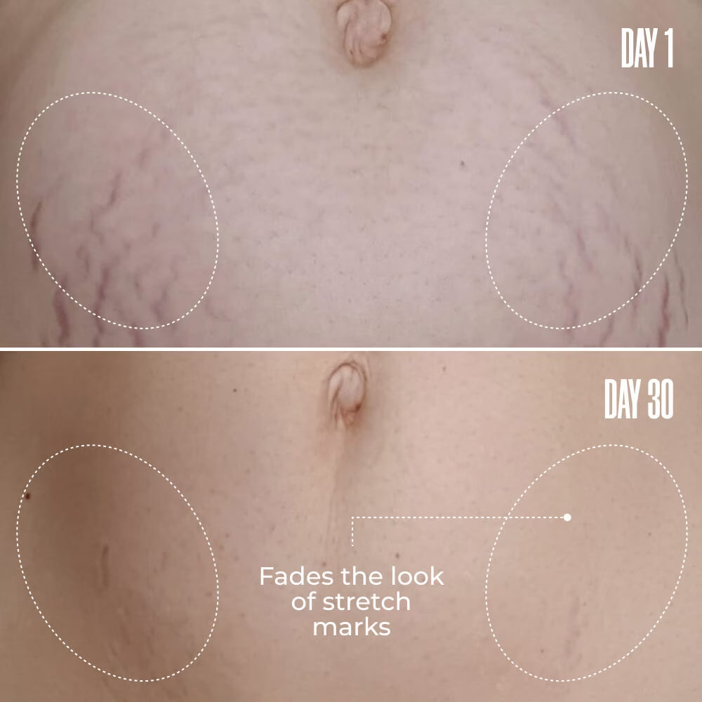 B-Flat Stretch Mark Removal Cream