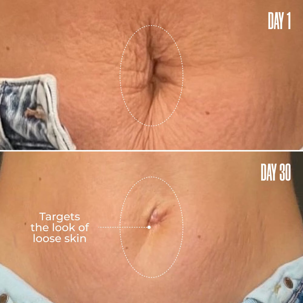 B-Flat Stretch Mark Removal Cream