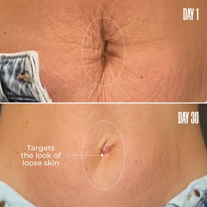 B-Flat Stretch Mark Removal Cream